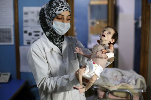 CORRECTION-A-Syrian-infant-suffering-f